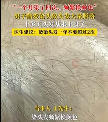 河南男子一月染髮四次 頭髮快掉光了