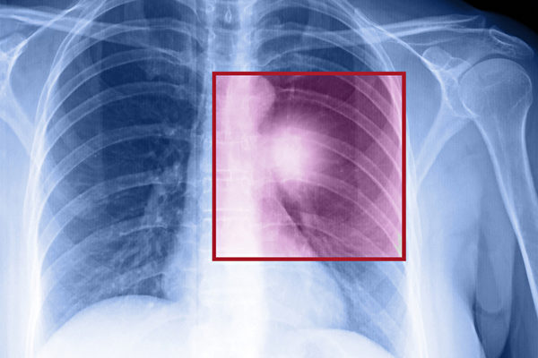 罕見基因突變 河南一家9人患癌8人離世