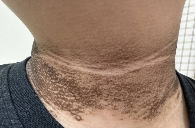 脖子黑≠没洗干净 黑色棘皮症上身啦!