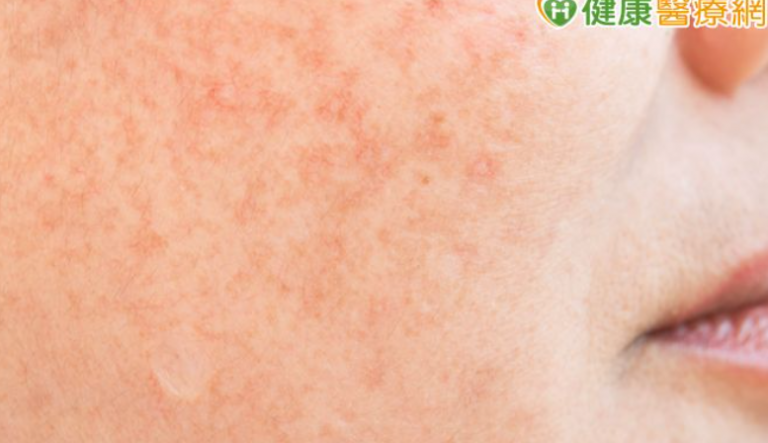 夏天脸红通通可能是酒糟肌! 医师分享护肤指南告别泛红、痘痘