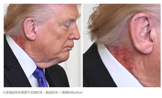 79岁川普「脖子红一片」还脱屑!战时健康再掀疑云 白宫御医曝真相