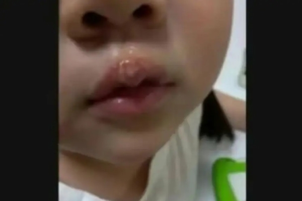 江蘇徐州幼童被曝遭教師用熱熔膠燙嘴
